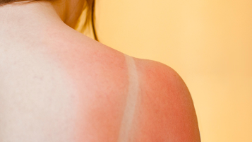 close up of a child's shoulder with sunburn and tan lines